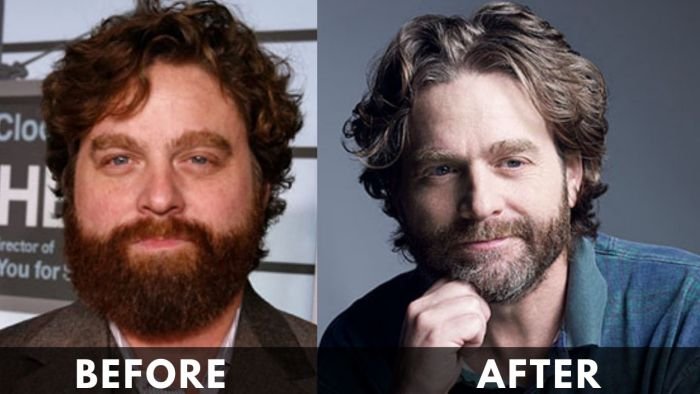 Zach Galifianakis Before After Weight Loss