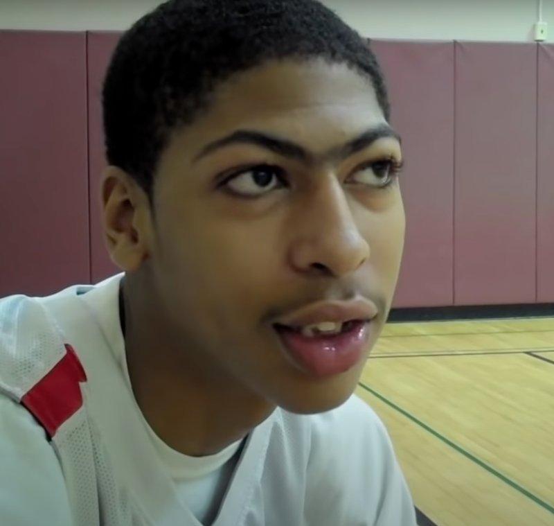 Anthony Davis Teeth before 1