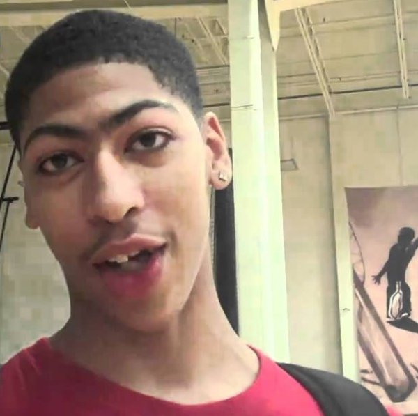 Anthony Davis Teeth before 3