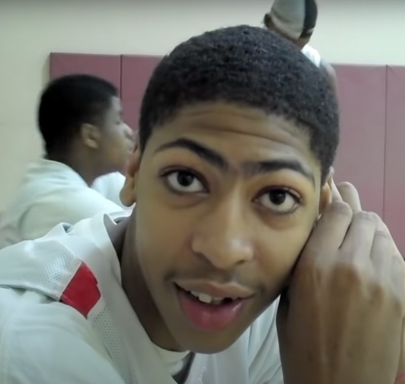 Anthony Davis teeth before 2