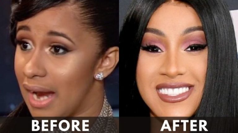 Cardi B Teeth Transformation: Surgery, Cost, Before And After