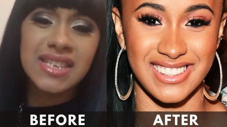 Cardi B Teeth Transformation: Surgery, Cost, Before And After