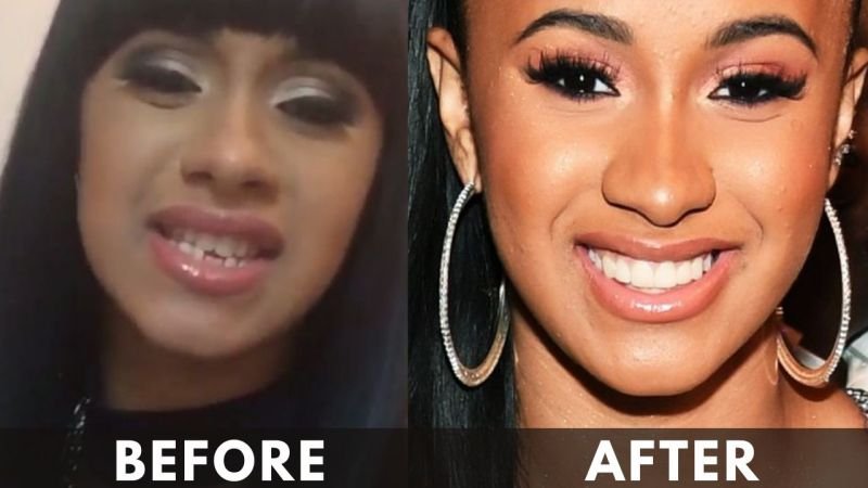 Cardi B Teeth before after