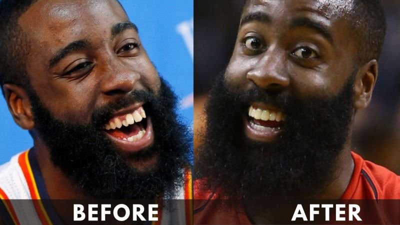 James Harden Before and after Teeth fix