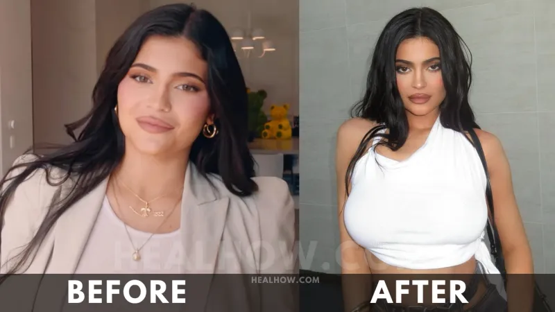 Kylie Jenner before after weight loss