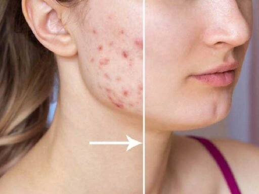 3 Ways In Which Laser Treatment Can Be Used To Treat Scars That Have Been Caused By Acne