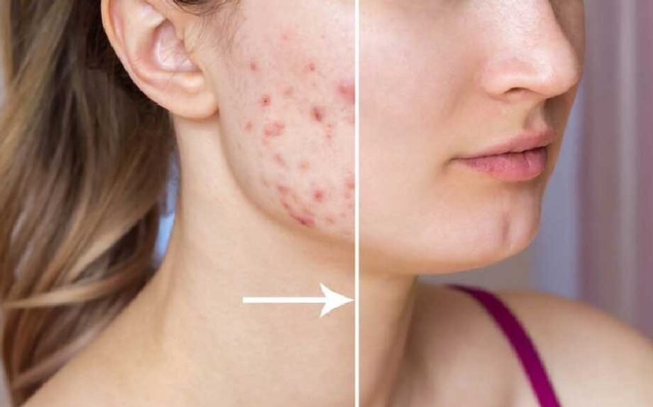 3 Ways In Which Laser Treatment Can Be Used To Treat Scars That Have Been Caused By Acne